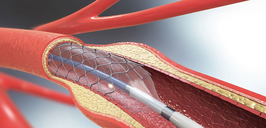 Best Cardiologist for Complex Angioplasty in South Mumbai
